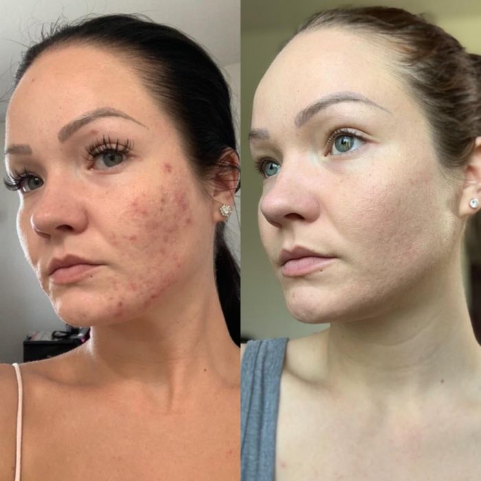 Two side-by-side photos showing the before-and-after effects on a woman's face, with clearer skin and reduced acne after the treatment.