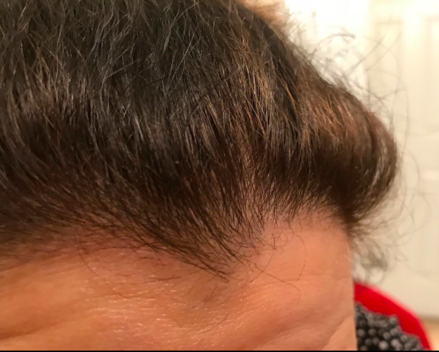 The same reviewer's hairline, now smooth and completely flake-free.
