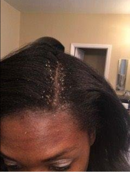 A reviewer's scalp, showing visible dandruff flakes around their part before treatment.