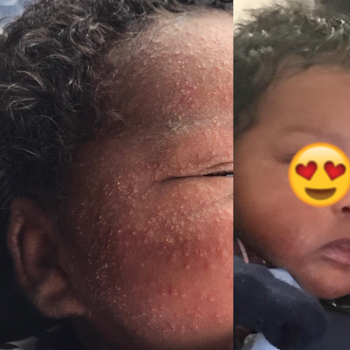 A reviewer's before-and-after photos: the first image displays eczema on their baby's face, while the second shows the skin cleared and healed