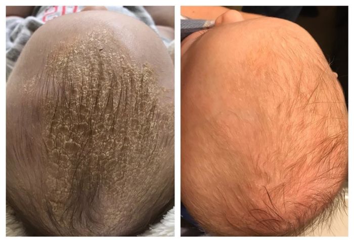 A baby's head with visible dry scales on the left, compared to the same baby's head looking smooth and free of flakes on the right