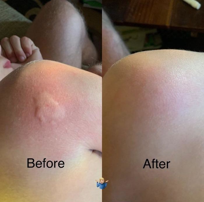 Reviewer's before-and-after images: the first shows a swollen mosquito bite, while the second reveals the bite completely gone after using the tool