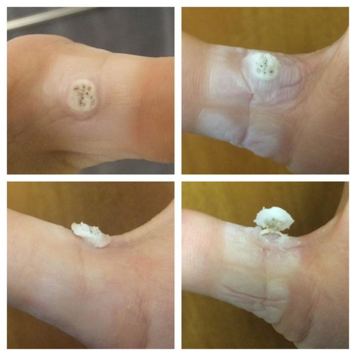 A reviewer's series of photos showing the gradual removal of a wart on their finger using the pads