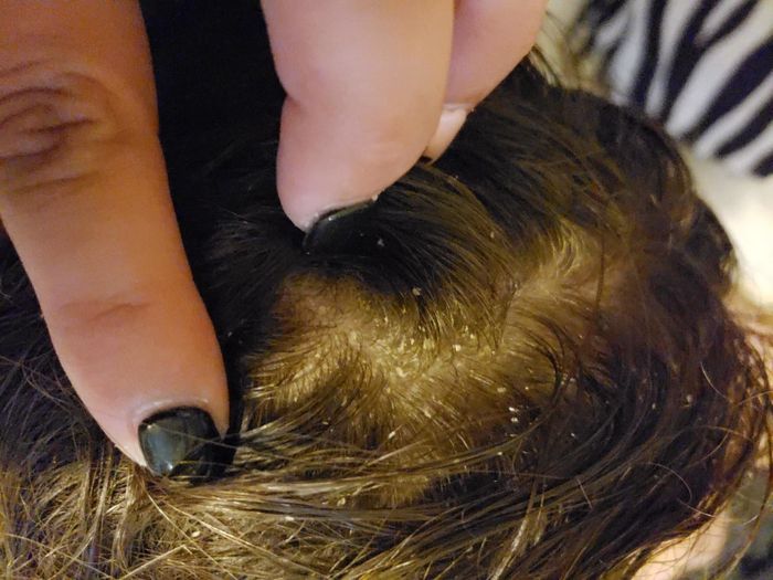 A reviewer's photo of a scalp with visible dandruff before using the shampoo