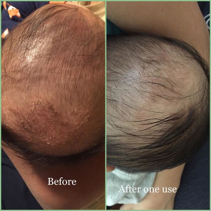 A reviewer's before-and-after photos: the first image reveals cradle cap on their baby's head, and the second demonstrates the condition fully resolved