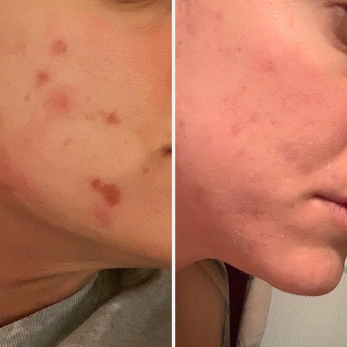 A reviewer's before-and-after photos showing the results of using the patches