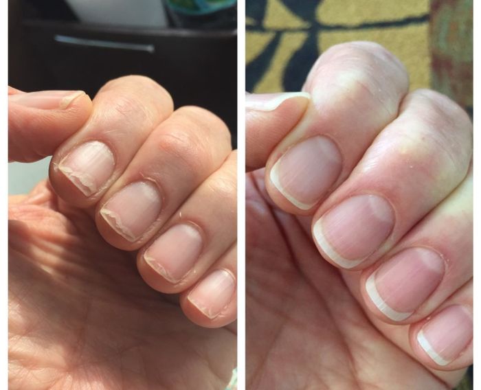 A before-and-after photo showing a hand with brittle, chipped nails and dry cuticles on the left, and the same hand with nourished, healthy nails and cuticles on the right