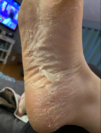 Reviewer foot with peeling skin.