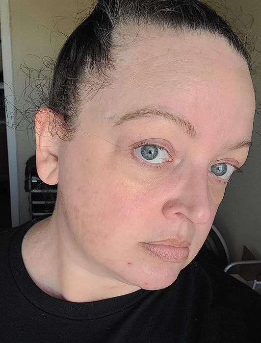 The same reviewer with most of the acne cleared up