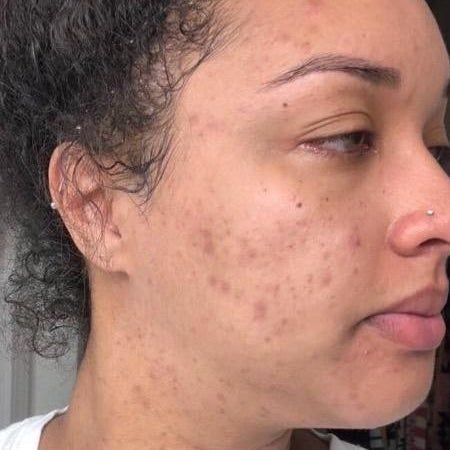 A reviewer showing blemishes on their cheek before using the spot treatment.