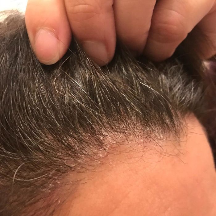 A photo of a reviewer’s dry, flaky scalp