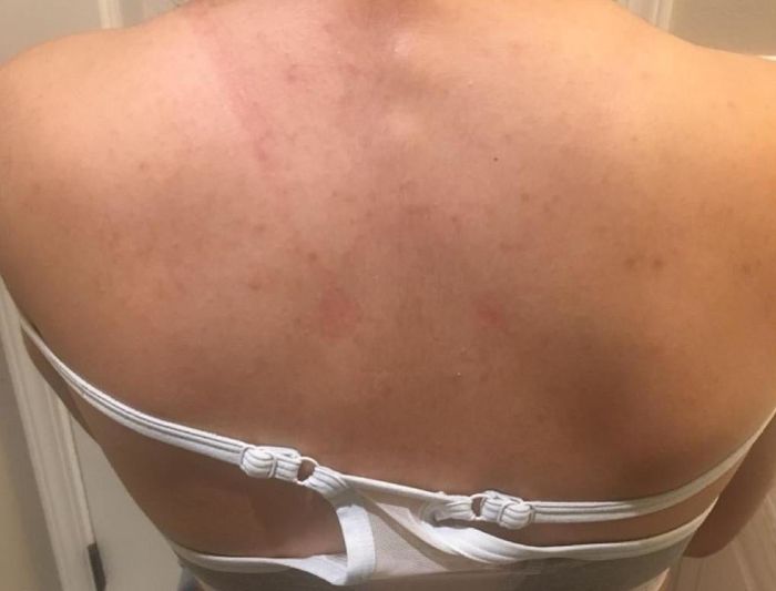 A reviewer’s back with most of the blemishes cleared up