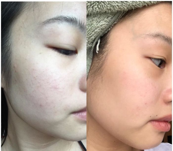 A split photo of a reviewer’s face showing red acne on the left, and a clear complexion on the right.