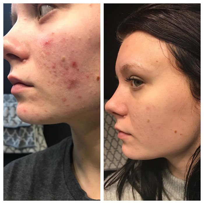 On the left, a reviewer with acne on their cheek and, on the right, the same reviewer with significantly clearer skin