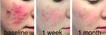 Reviewer photo showing a highly inflamed patch of rosacea on the cheek with raised rashes, followed by a lighter pink hue after one week of use, and an even lighter appearance after a month.