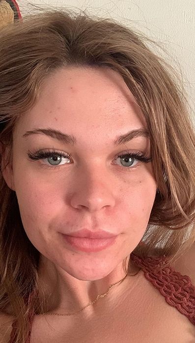 The same reviewer a month later with most of the acne cleared up.