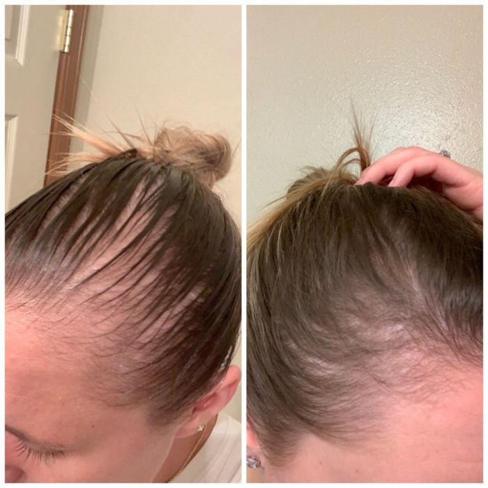On the left, reviewer has thinning hair. On the right, after using the shampoo, their hair appears fuller