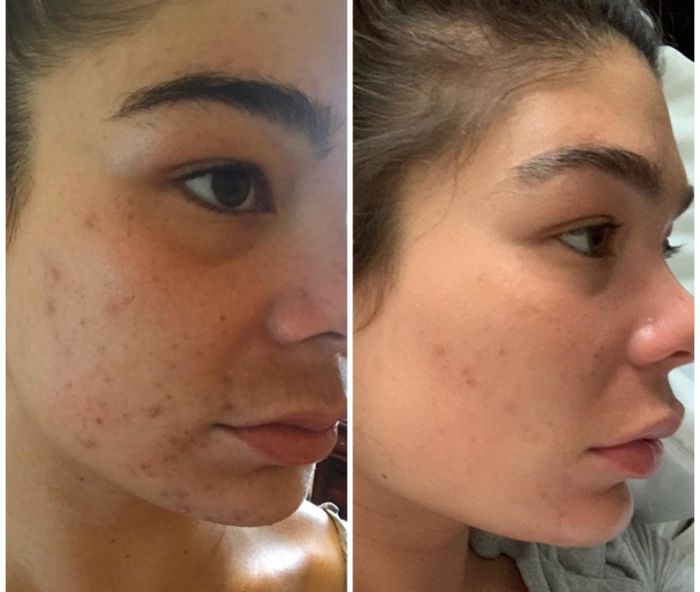 A split image of a face with red bumps and acne scars on the left, and the same face with reduced bumps and scars on the right.