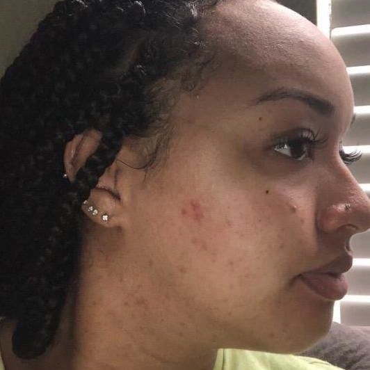 The same reviewer with noticeably fewer blemishes on their cheek.