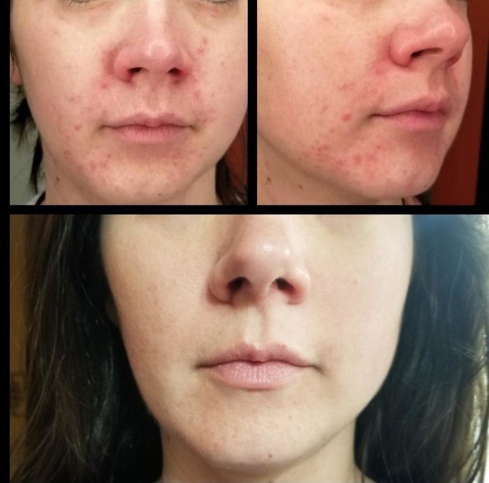 A split before-and-after photo showing a reviewer with acne around their chin in the first image, followed by a clear complexion in the second.