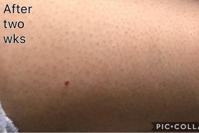 An after photo of the same reviewer showing much less irritation