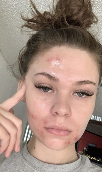 A reviewer showing blemishes on their cheeks and forehead.