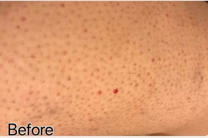 A photo of a reviewer’s skin with irritated hair follicles and ingrown hairs