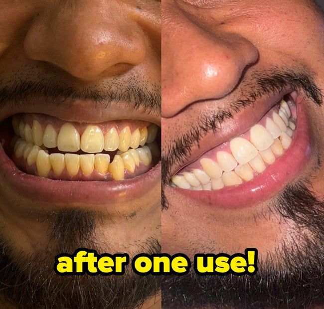 A before-and-after comparison of teeth whitening results, with the left image showing discolored teeth and the right image displaying a brighter, whiter smile