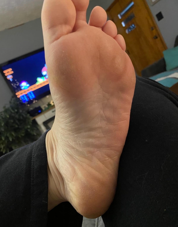 Reviewer foot with peeled skin.