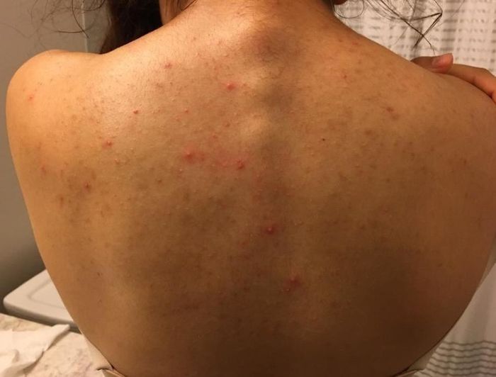 A reviewer’s back covered in pimples