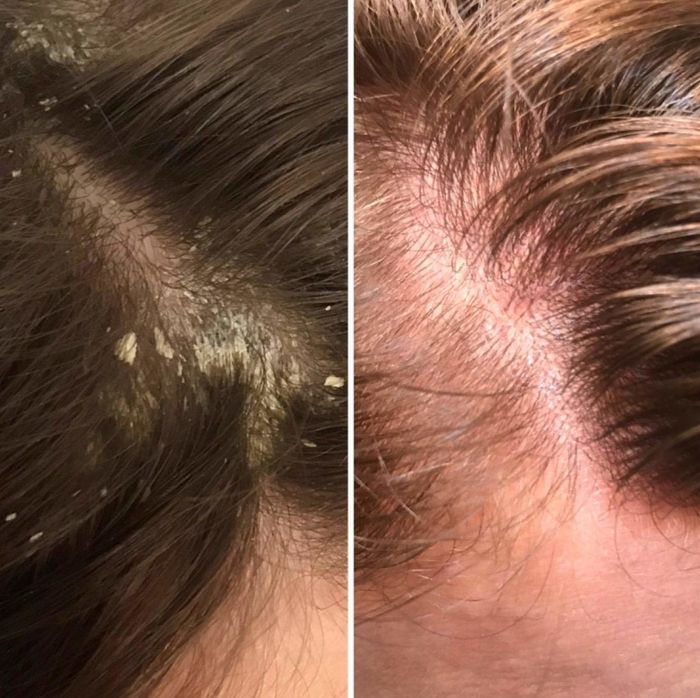A before-and-after image showing a scalp covered in dandruff on the left and a clear scalp on the right.
