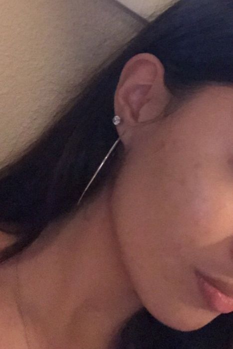 The same reviewer noticed significant improvement, with most of the acne cleared up.