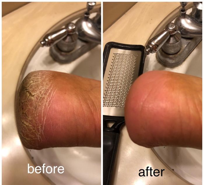 Before-and-after photo showing a callused foot (left) and a smooth, callus-free foot (right) alongside a silver foot file.