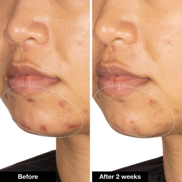 Close-up of a person's lower face showing noticeable skin improvement from acne treatment after two weeks.