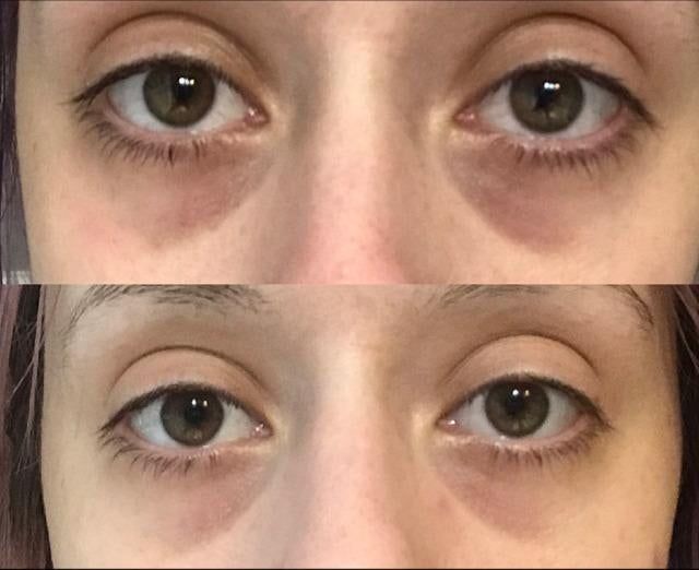 A reviewer showing the results after using CeraVe eye cream.