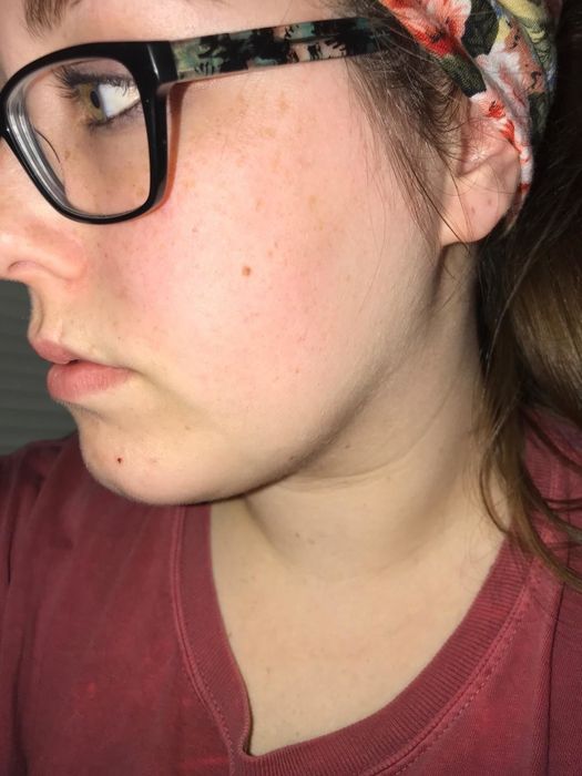 A customer review featuring a photo of the same cheek, now significantly less red and nearly free of breakouts.