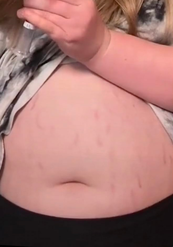 Close-up image of a person's abdomen with noticeable stretch marks, demonstrating a skincare regimen or product application