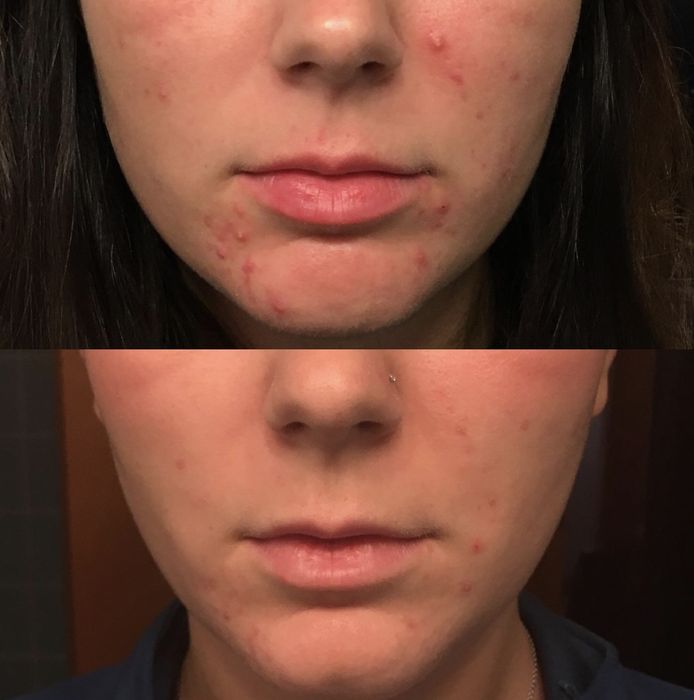 Before and after comparison of a person's skin treatment showing visible improvement in acne.