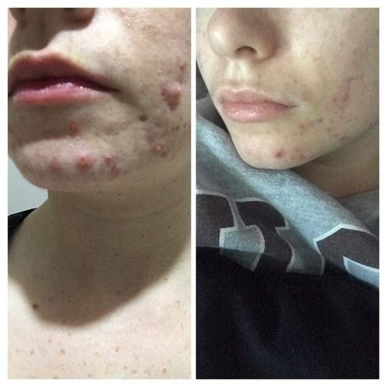 On the left, the reviewer's chin is covered with acne; on the right, the same chin shows visible improvement, with much less acne after regular use of the clay mask once a week.