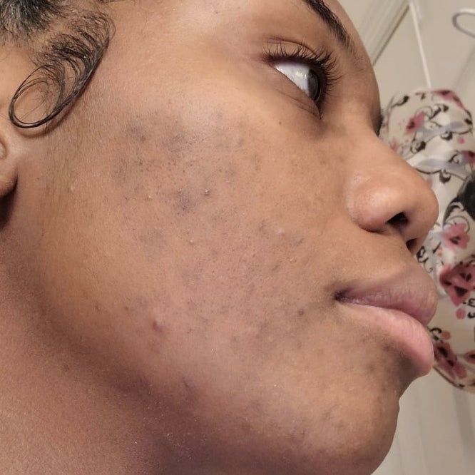 Close-up side view of a person’s cheek showing skin blemishes