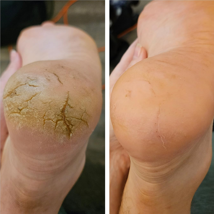 Before-and-after images showing a callused foot that has been softened using the gel.