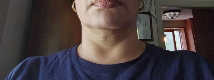Reviewer's neck prior to using the cream