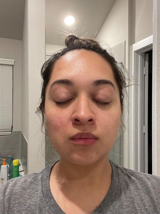 Reviewer before applying acne spray