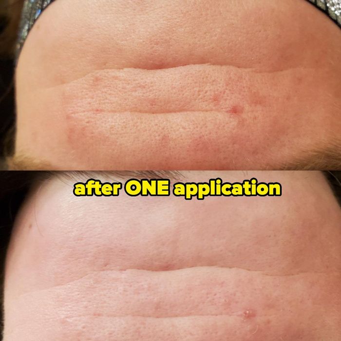 Before and after comparison of a reviewer's forehead, showing smoother skin and reduced pore visibility after just one use