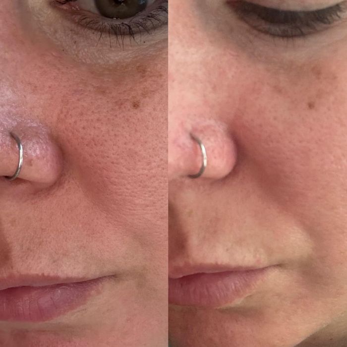 Close-up of reviewer's pores before and after using toner pads