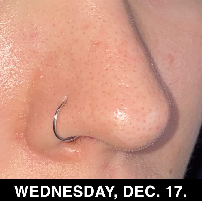 A reviewer's nose after applying Paula's Choice BHA serum.