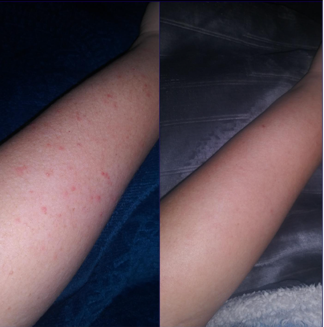 Before and after images of a reviewer showing bumps on their arm and then after using the product, with clearer skin.