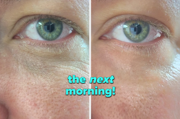 A reviewer's under-eye area showing wrinkles before and much smoother skin after.