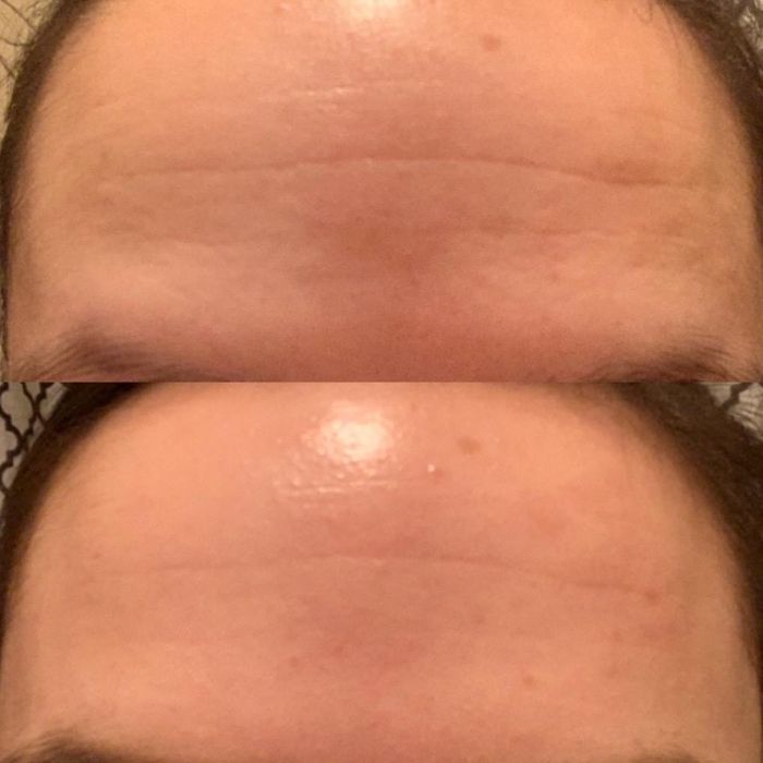 Close-up of a forehead before and after applying Roc cream