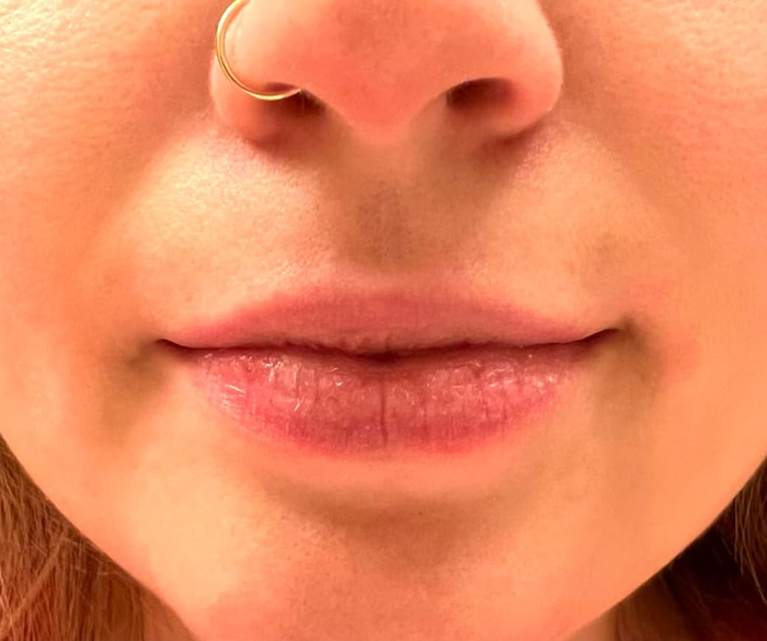Close-up shot of a person's lips and nose, highlighting chapped lips